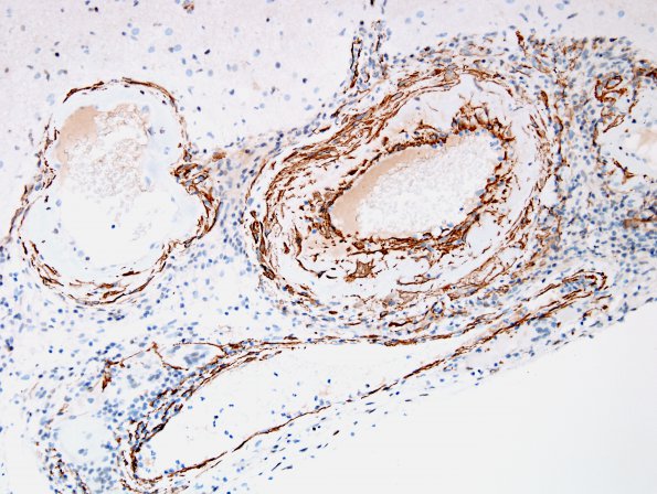 8E2 Angiitis, granulomatous vs ABRA (Case 8) SMA 7