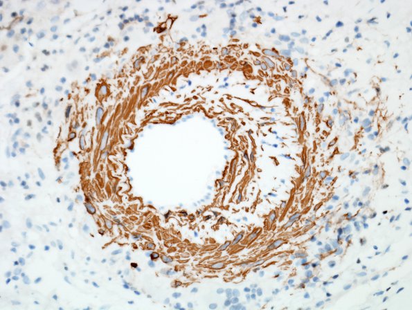 8E3 Angiitis, granulomatous vs ABRA (Case 8) SMA 6