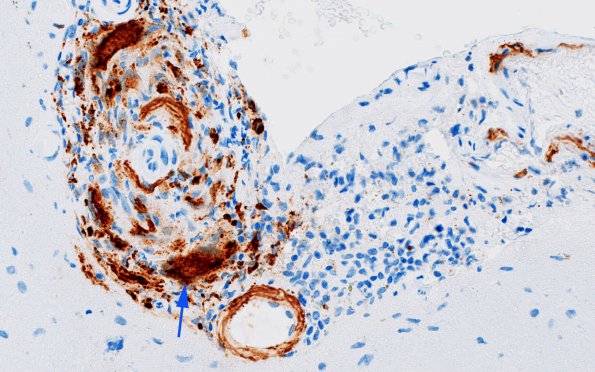 9C2 ABRA (Case 9) B-amyloid 3 copy