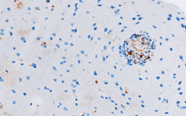 9B3 ABRA (Case 9) B-amyloid 4