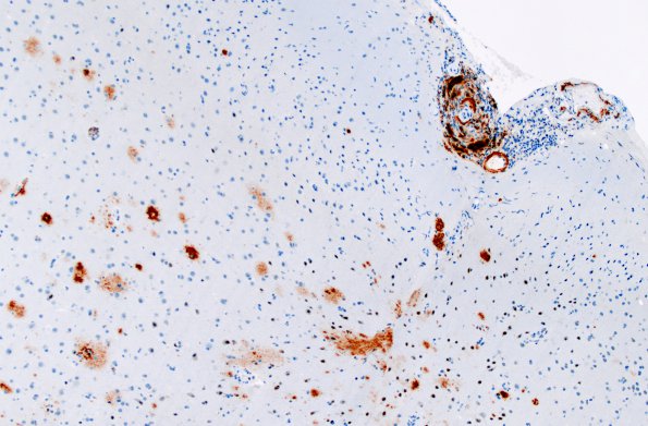 9C1 ABRA (Case 9) B-amyloid 1