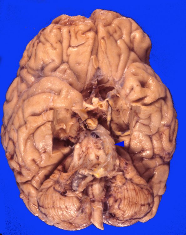 1A1 Aneurysm, fusiform (Case 1) 2 copy