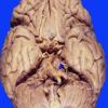 2A Atherosclerosis (Case 2) gross 1 copy