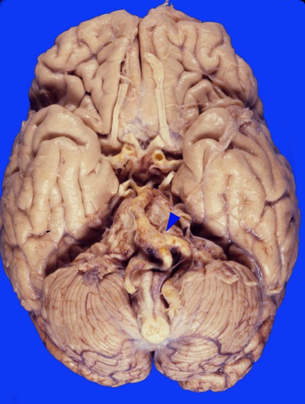 2A Atherosclerosis (Case 2) gross 1 copy