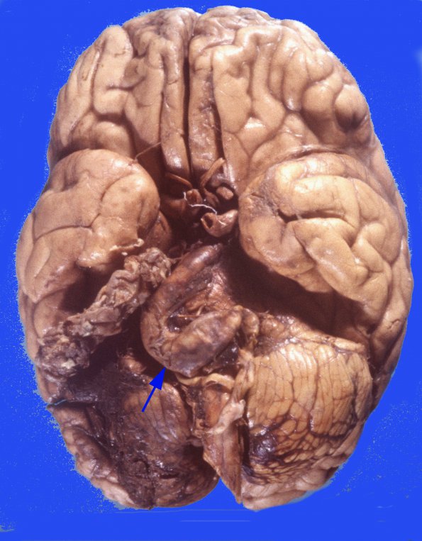 3 Aneurysm, atheromatous (Case 3) copy