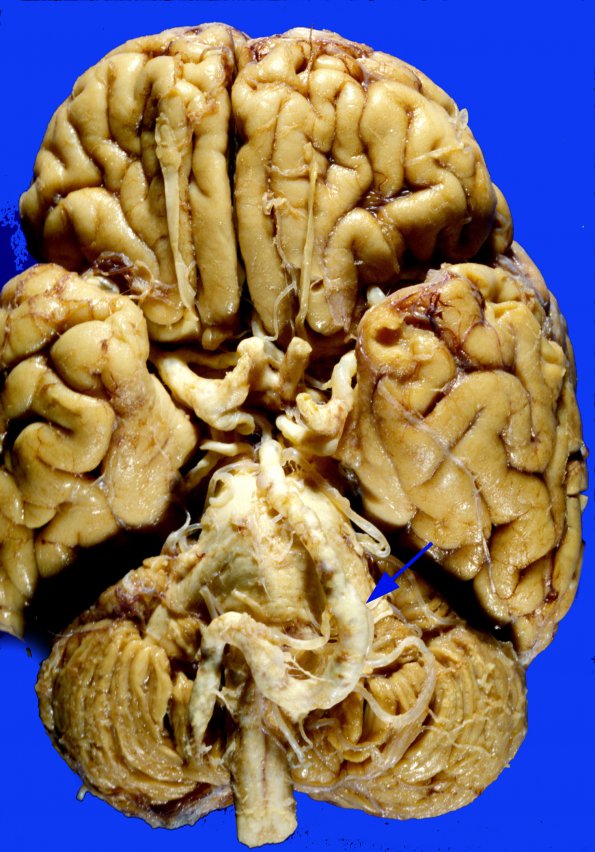 4 Atherosclerosis (Case 4) 1 carotid copy