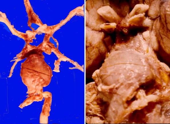 5A1 Mixed images (Case 5) Fusiform Aneurysm