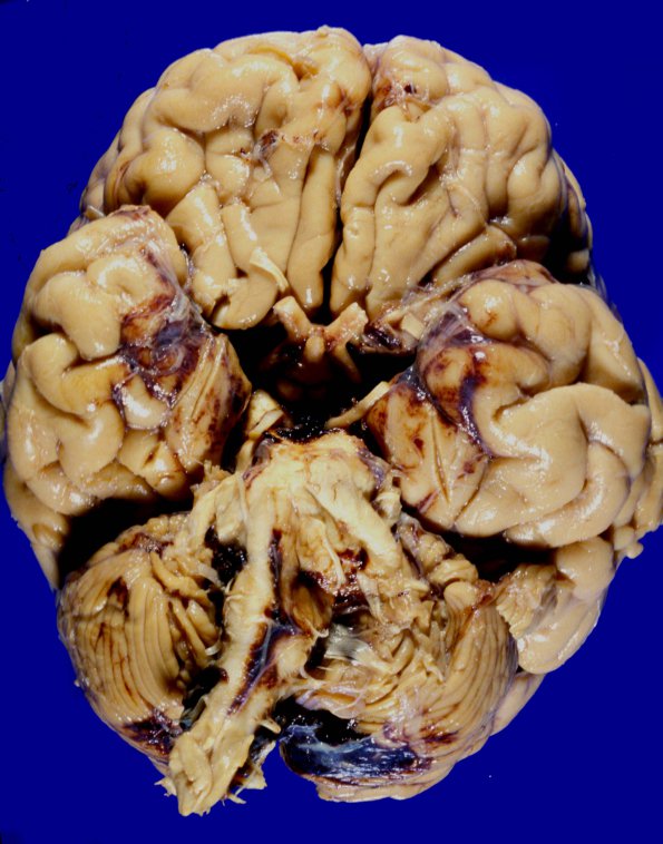 1A3 Aneurysm (Case 1) gross 2