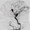 4A1 Aneurysm, giant (Case 4) Angio 2005 2 - Copy A copy