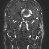 4A2 Aneurysm, giant (Case 4) MRA PHASE 1 W 1 - Copy