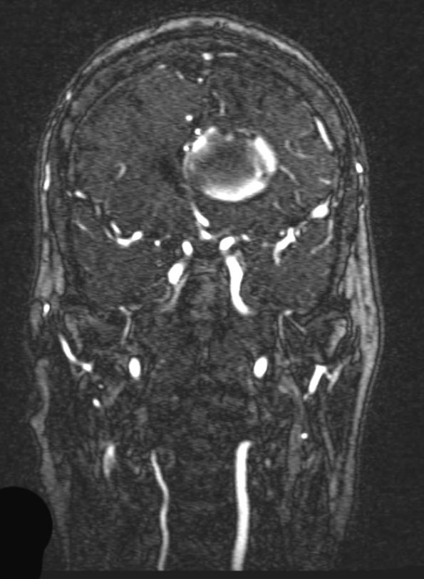 4A2 Aneurysm, giant (Case 4) MRA PHASE 1 W 1 - Copy