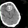 4A3  Aneurysm, giant (Case 4) CT 1 - Copy