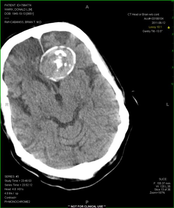 4A3  Aneurysm, giant (Case 4) CT 1 - Copy