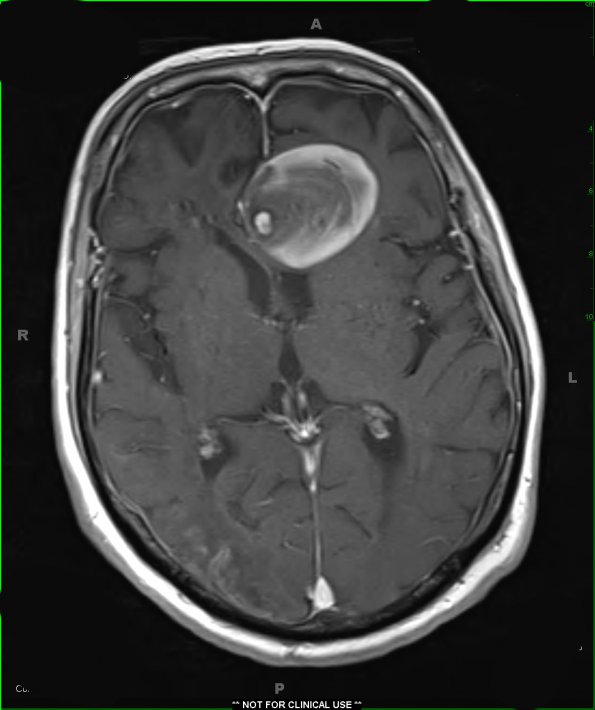 4A4  Aneurysm, giant (Case 4)  (vessel origin) T1 W 2 - Copy