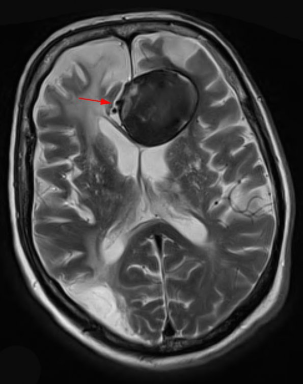 4A5  Aneurysm, giant (Case 4) (vessel origin) T2 4 - Copy copy