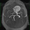 4A6  Aneurysm, giant (Case 4) COW MIP TRA 1 - Copy