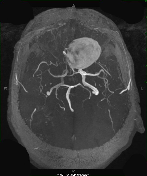 4A6  Aneurysm, giant (Case 4) COW MIP TRA 1 - Copy