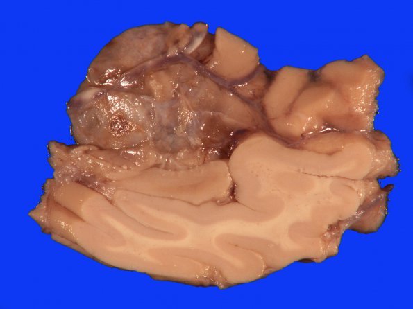 4B2 Aneurysm, chronic (Case 4) 4