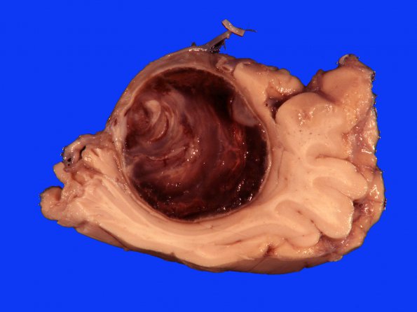 4B3 Aneurysm, giant (Case 4) 5