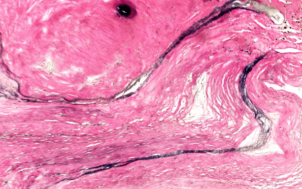 4C5 Giant Aneurysm (Case 4) N18 VVG 20X 2