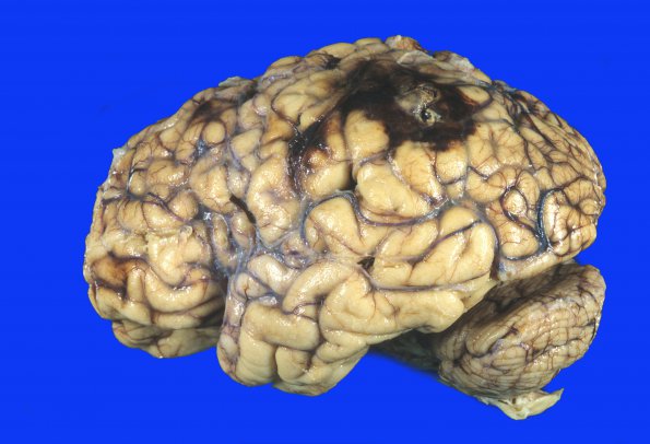 1A1 Aneurysm, mycotic (Case 1) 1