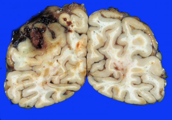 1A2 Aneurysm, mycotic (Case 1) 3A