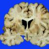 1A3 Aneurysm, mycotic (Case 1) 11