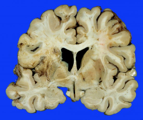 1A3 Aneurysm, mycotic (Case 1) 11