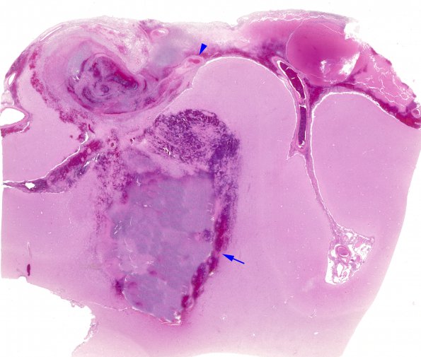 1B1 Aneurysm, mycotic (Case 1) H&E WM (adobe)