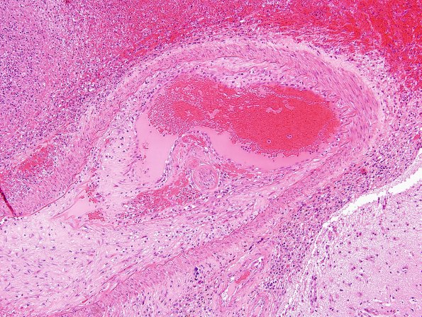 1B2 Aneurysm, mycotic (Case 1) H&E 2 (2)