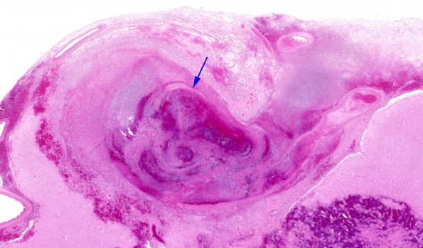 1B3 Aneurysm, mycotic (Case 1) H&E WM 2