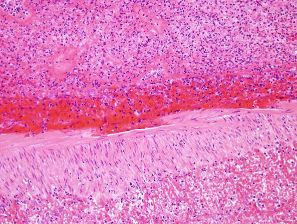 1B4 Aneurysm, mycotic (Case 1) H&E 1 (artery wall & thrombus)