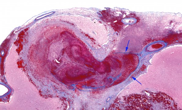 1C2 Aneurysm, mycotic (Case 1) Trichrome whole mount 2 copy