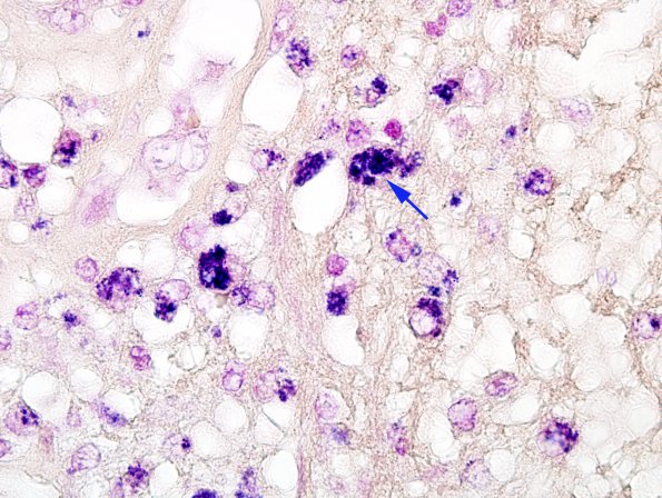 1E1 Aneurysm, mycotic (Case 1) Gram 100X 1