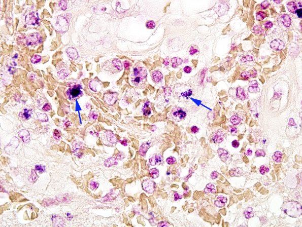 1E2 Aneurysm, mycotic (Case 1) Gram 100X 2