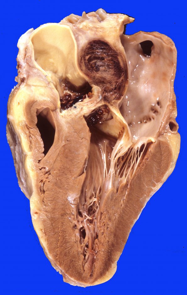 1F1 Aneurysm, mycotic (Case 1) heart