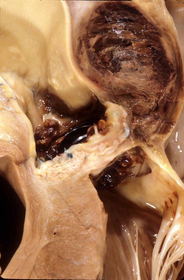 1F2 Aneurysm, mycotic (Case 1) Heart 3