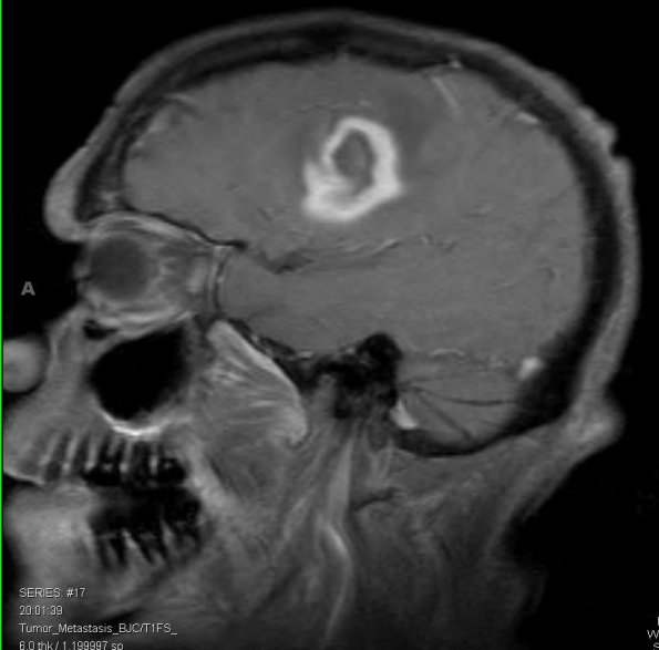 2A1 Aneurysm, mycotic (Case 2) Abscess T1 1 - Copy