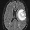 2A2 Aneurysm, mycotic (Case 2) Abscess T2 - Copy