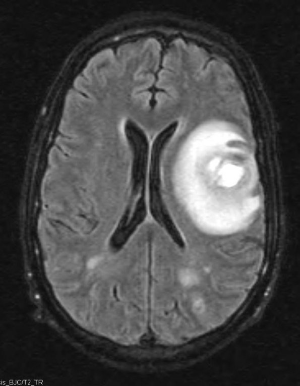 2A2 Aneurysm, mycotic (Case 2) Abscess T2 - Copy