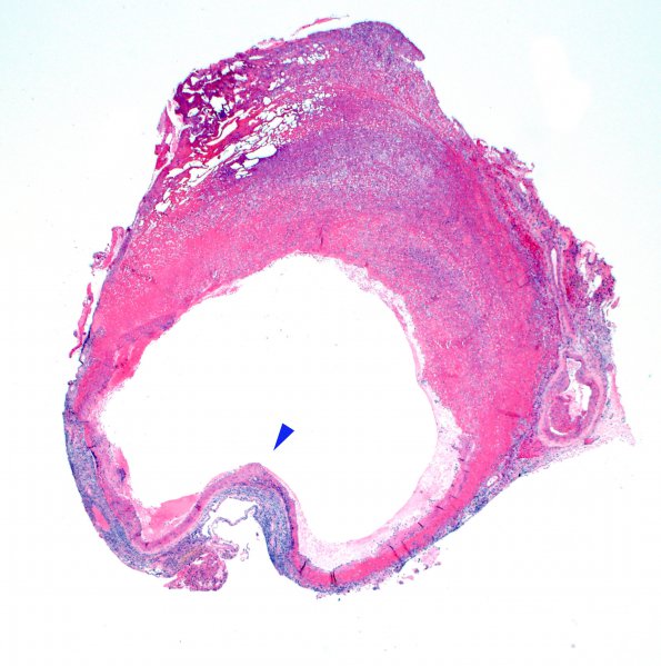 2B1 Aneurysm, mycotic (Case 2) 2X H&E 1 copy