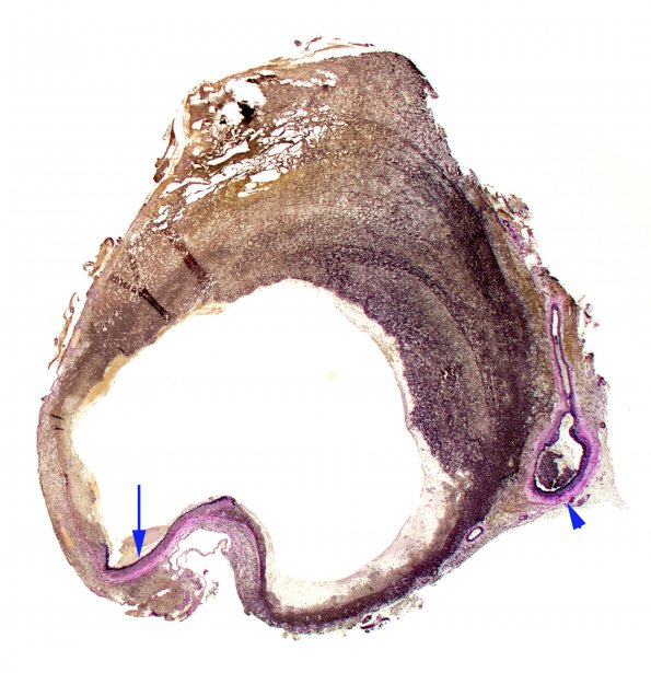 2B2 Aneurysm, mycotic (Case 2) 2X VVG 3 copy