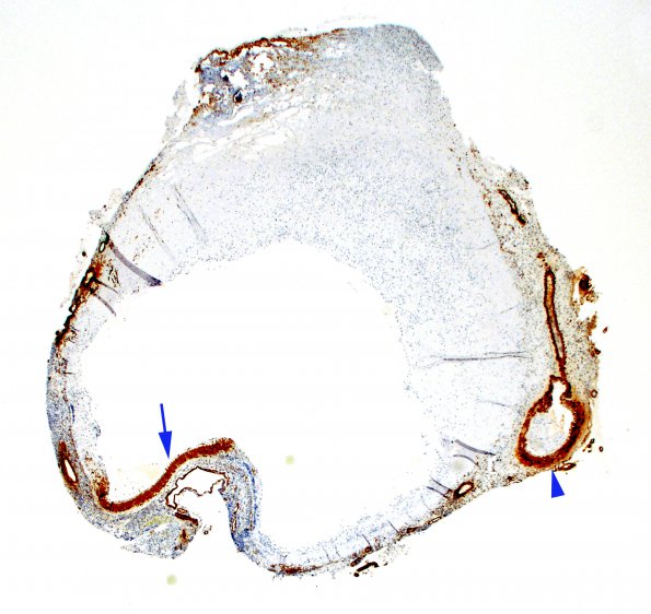 2B3 Aneurysm, mycotic (Case 2) 2X SMA 1 copy