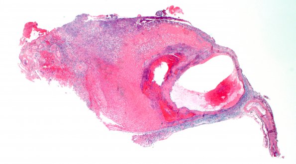 2B4 Aneurysm, mycotic (Case 2) 2X H&E 2