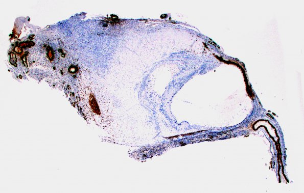 2B6 Aneurysm, mycotic (Case 2) 2X SMA 2