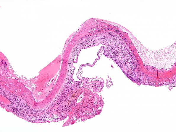 2C1 Aneurysm, mycotic (Case 2) H&E 3