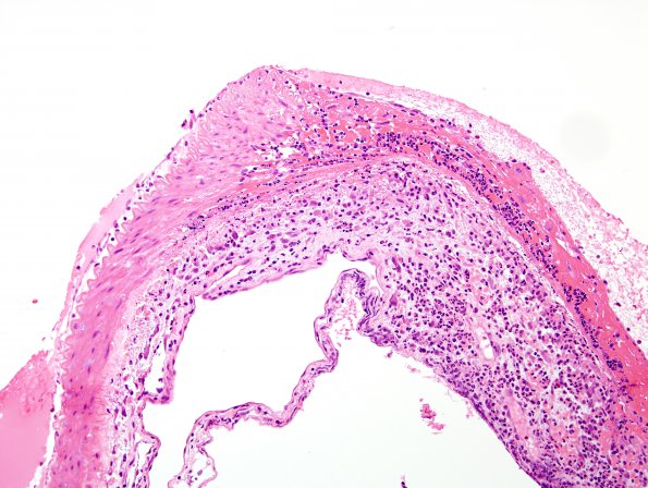 2C2 Aneurysm, mycotic (Case 2) H&E 1