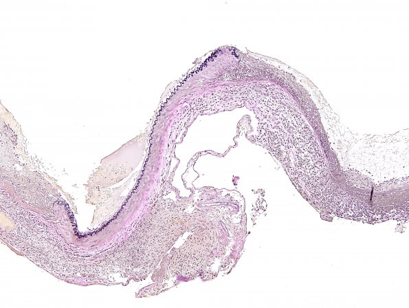 2C3 Aneurysm, mycotic (Case 2) VVG 3