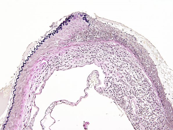 2C4 Aneurysm, mycotic (Case 2) VVG 2