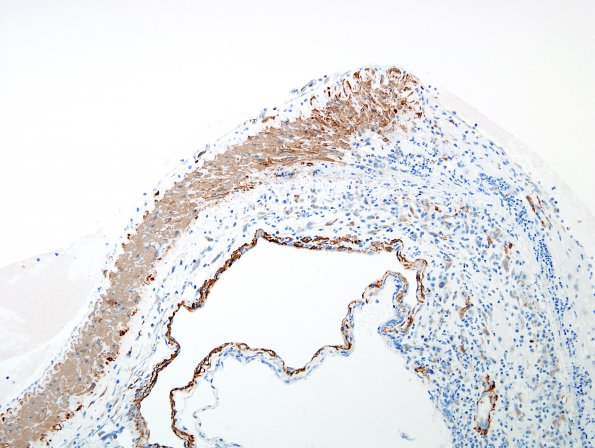 2C5 Aneurysm, mycotic (Case 2) SMA 1